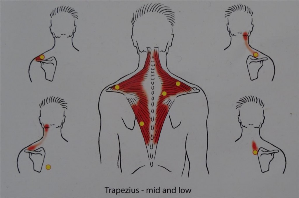 Trigger and dry needle points of trapezius. source:  David Legge D.O, Sydney press.