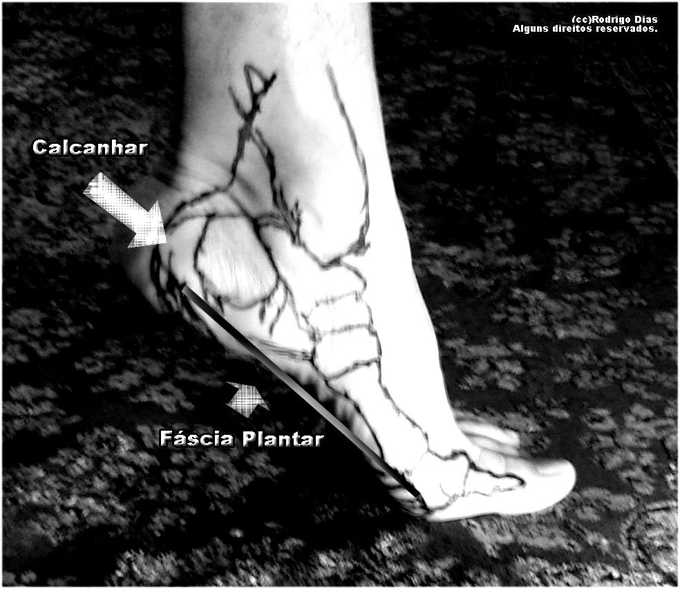 fasciaplantar-lateral